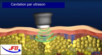 cavitation par ultrason
