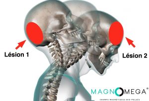 Whiplash, syndrome post-commotionnel