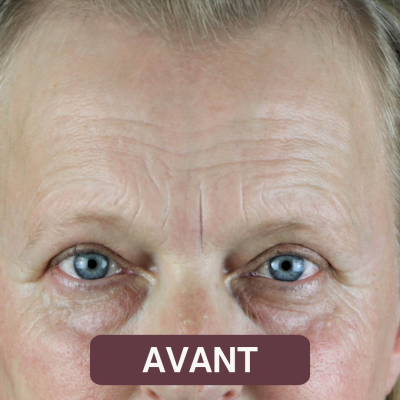 L'avant-après du NOVAFON